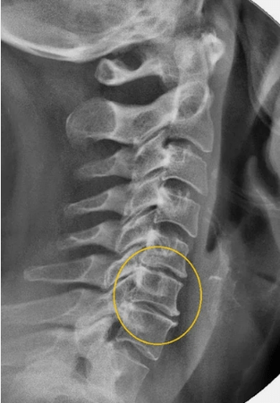 Ostéochondrose de la colonne cervicale dans une ligne X
