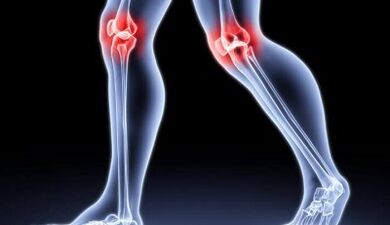 Prévention de l'arthrite et du développement de l'arthrose