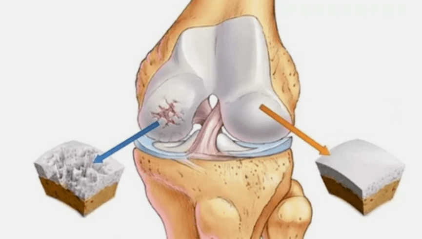 Comment se développe l'arthrose