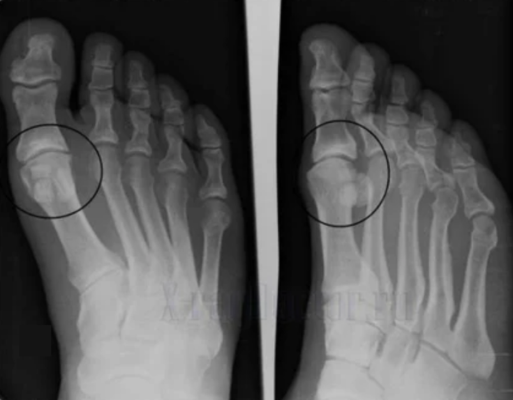 Diagnostic d'arthrose