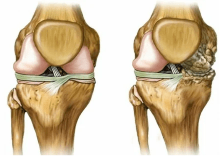 Étapes de l'arthrose