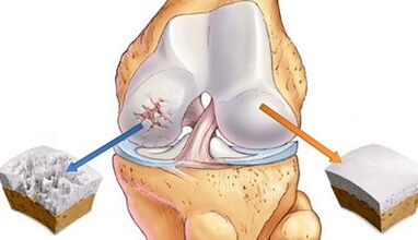 causes de l'arthrose des articulations