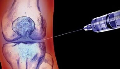 méthodes pour traiter l'arthrose articulaire
