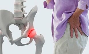 causes de l'arthrose de la hanche
