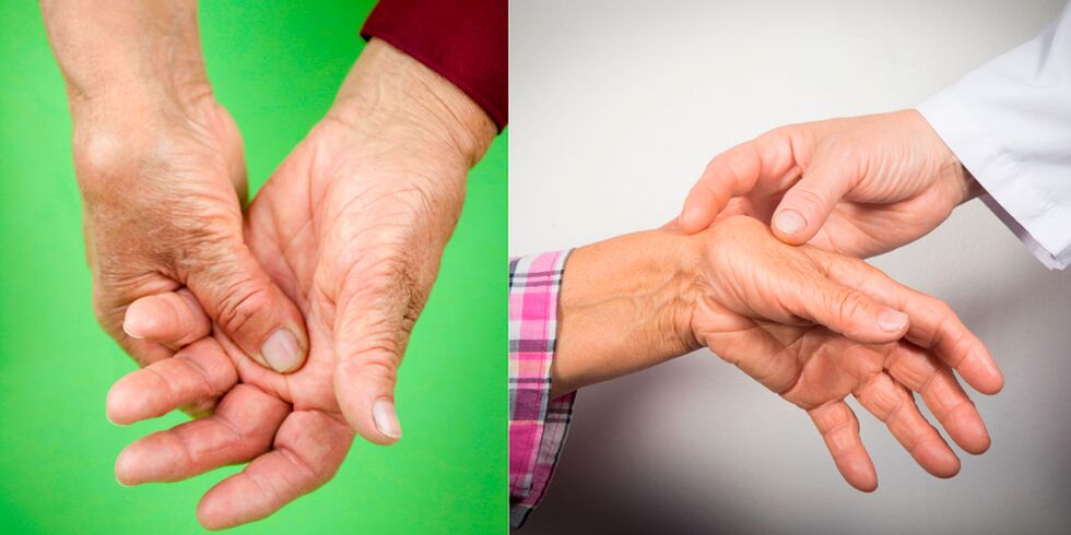 gonflement et douleur sont les premiers signes d'arthrite de la main