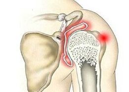 destruction de l'articulation de l'épaule avec arthrose