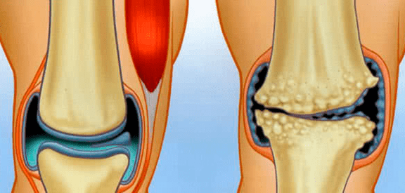 Articulation normale et arthrose normale